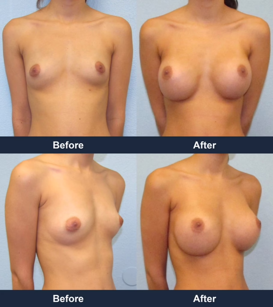 Breast Augmentation - Before and After Images with Dr. Chaudhari