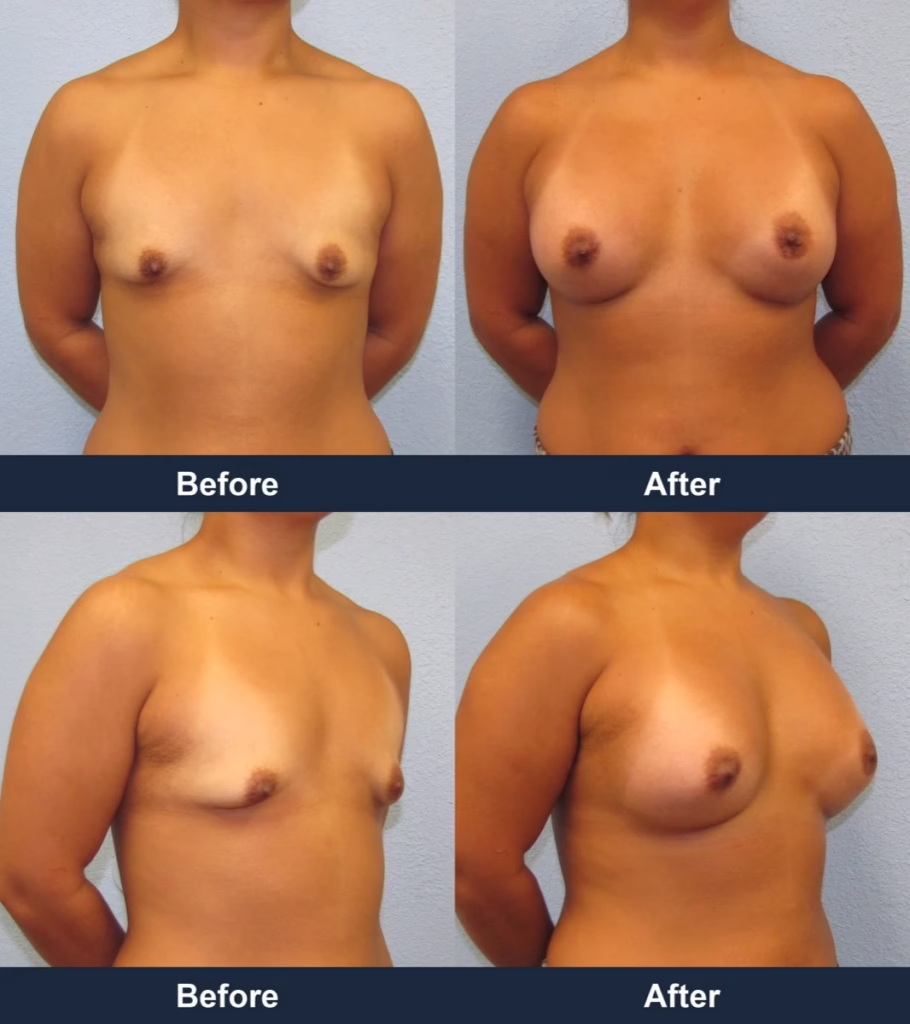 Breast Augmentation - Before and After Images with Dr. Chaudhari
