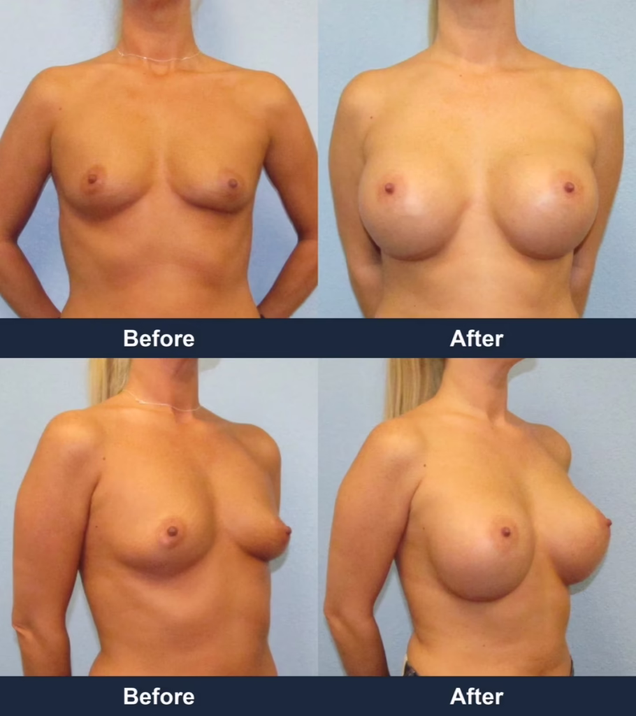 Breast Augmentation - Before and After Images with Dr. Chaudhari