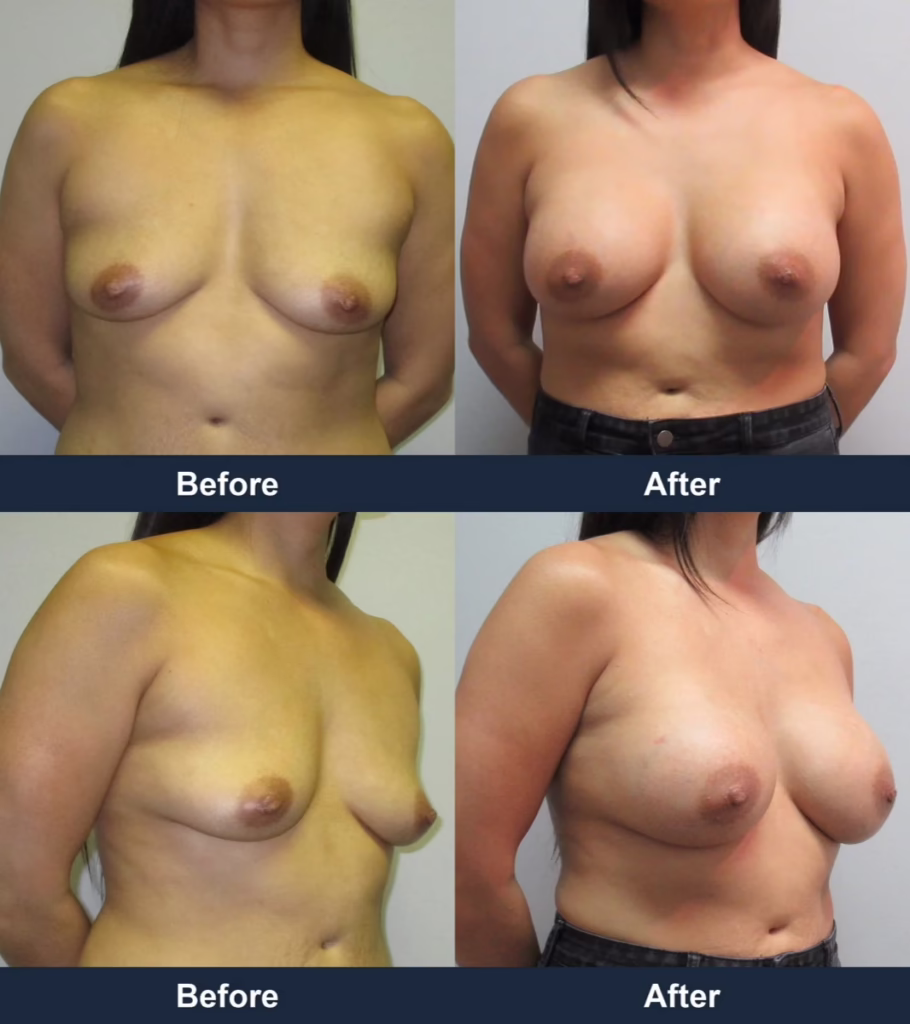 Breast Augmentation - Before and After Images with Dr. Chaudhari
