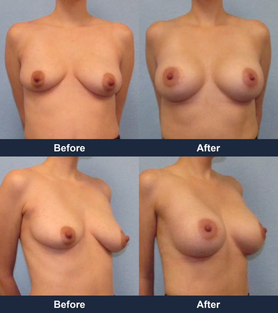 Breast Augmentation - Before and After Images with Dr. Chaudhari