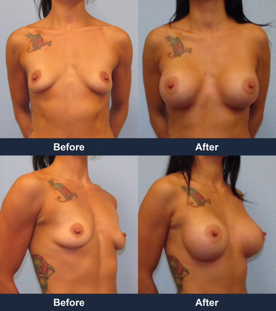 Breast Augmentation - Before and After Images with Dr. Chaudhari