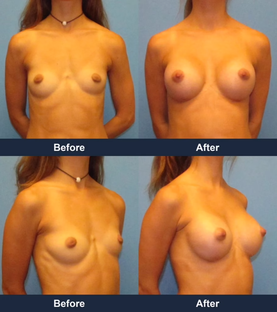 Breast Augmentation - Before and After Images with Dr. Chaudhari