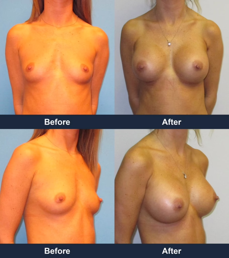 Breast Augmentation - Before and After Images with Dr. Chaudhari