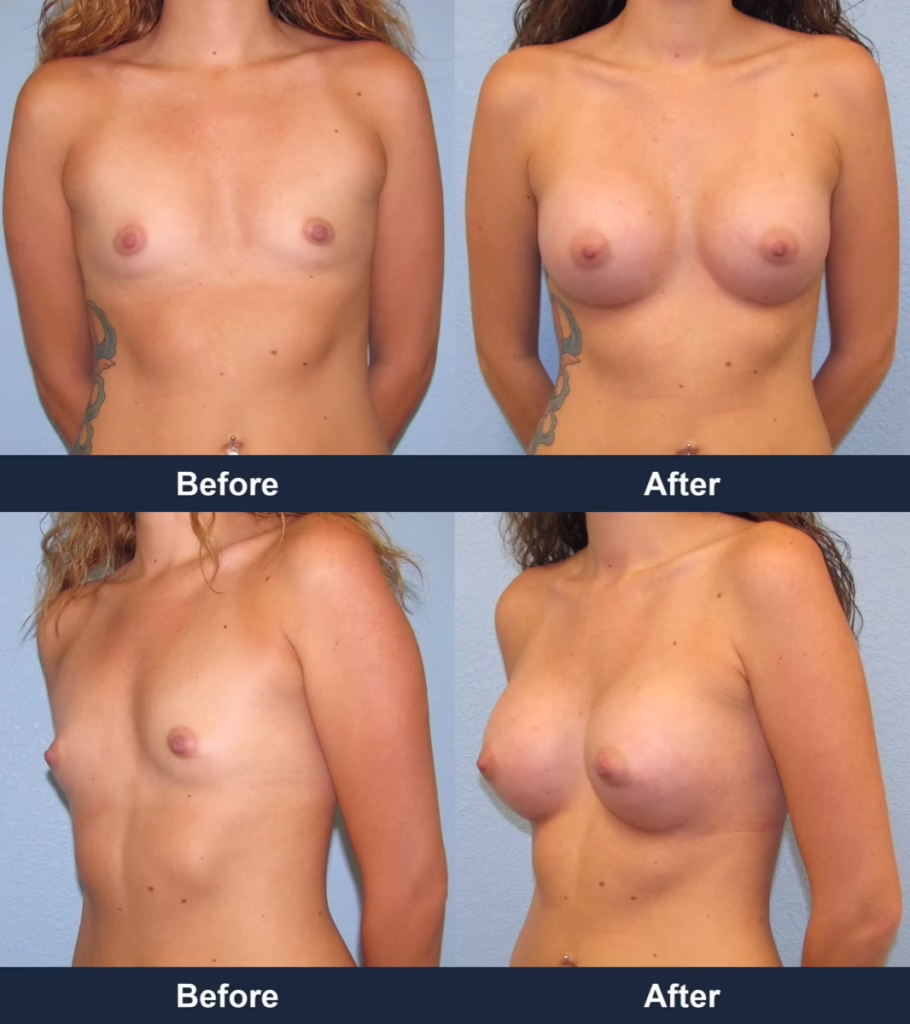 Breast Augmentation - Before and After Images with Dr. Chaudhari