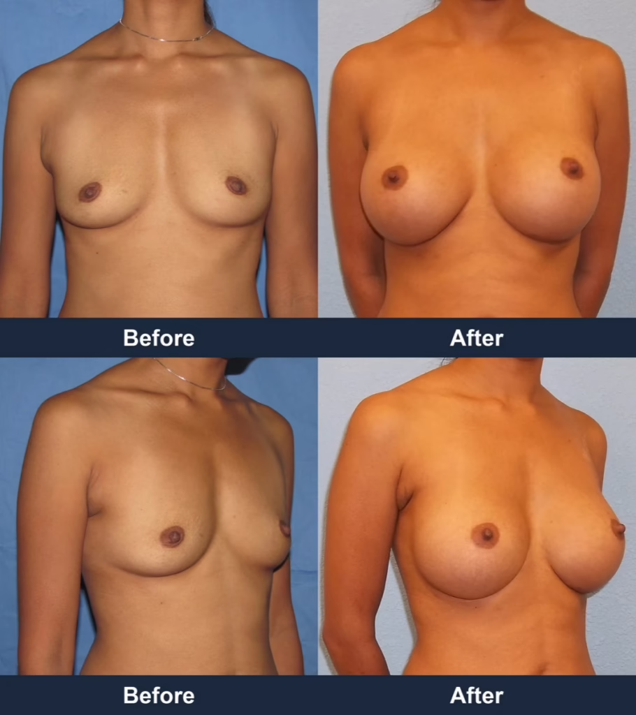 Breast Augmentation - Before and After Images with Dr. Chaudhari