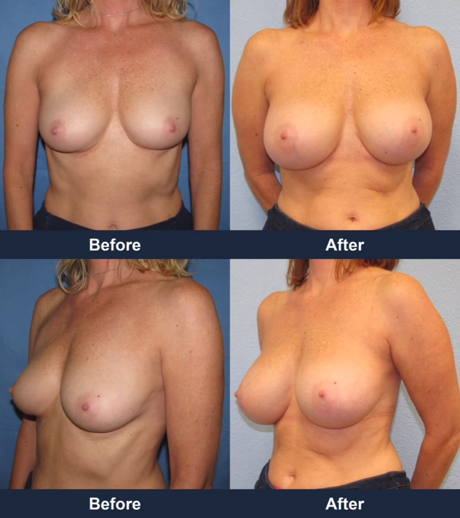 Breast Augmentation - Before and After Images with Dr. Chaudhari