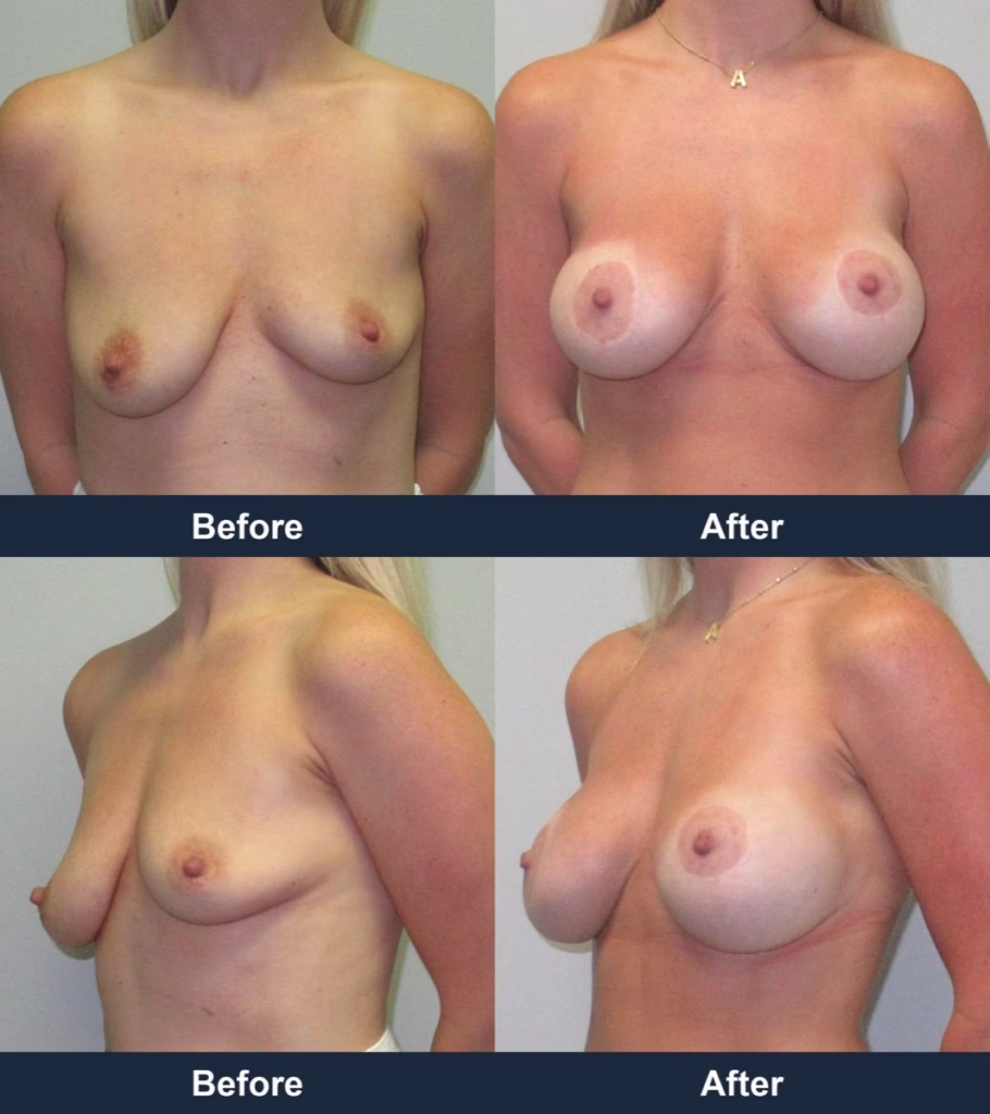 Breast Augmentation - Before and After Images with Dr. Chaudhari