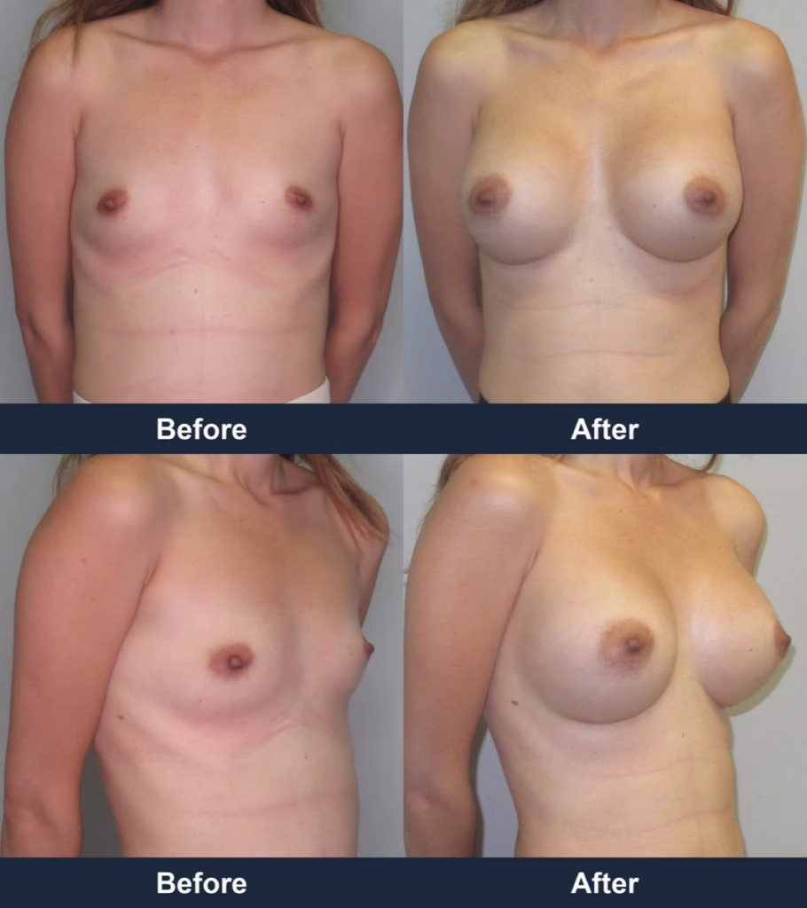 Breast Augmentation - Before and After Images with Dr. Chaudhari