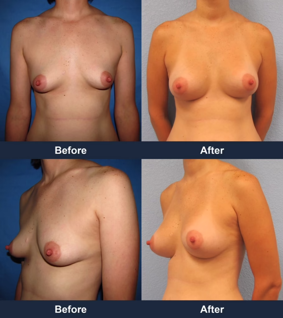 Breast Augmentation - Before and After Images with Dr. Chaudhari