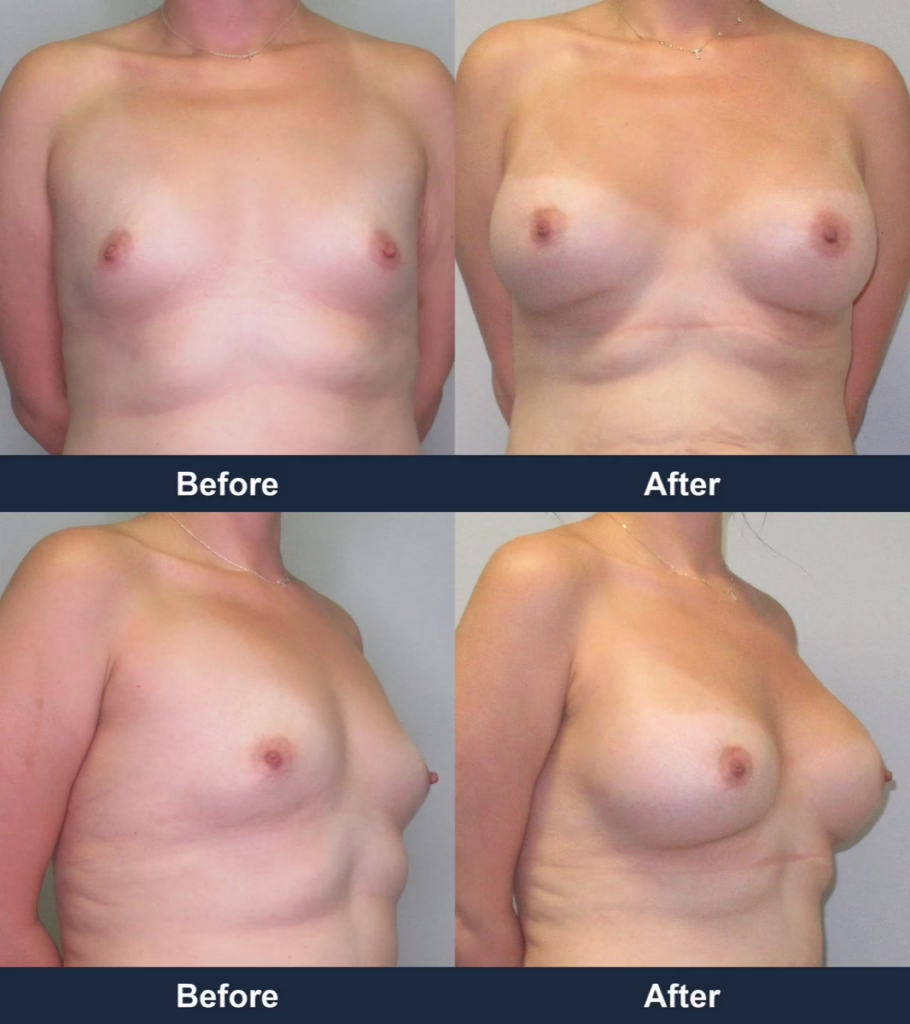 Breast Augmentation - Before and After Images with Dr. Chaudhari