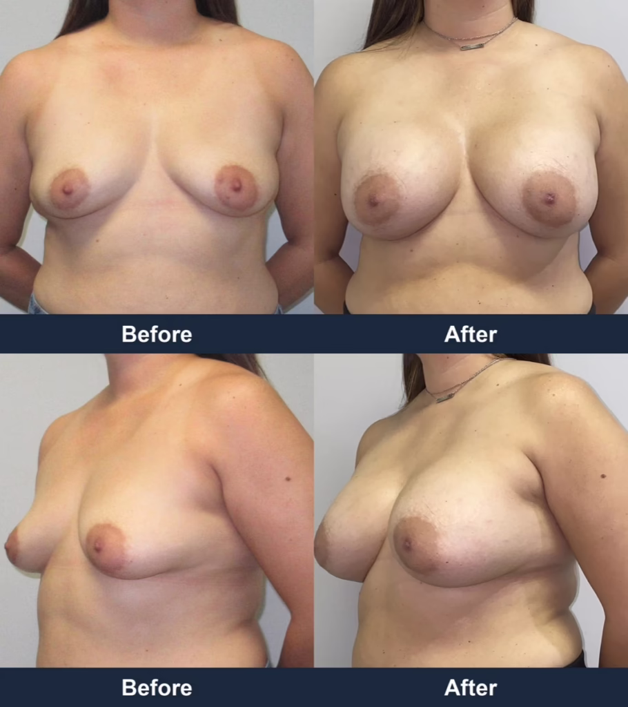 Breast Augmentation - Before and After Images with Dr. Chaudhari