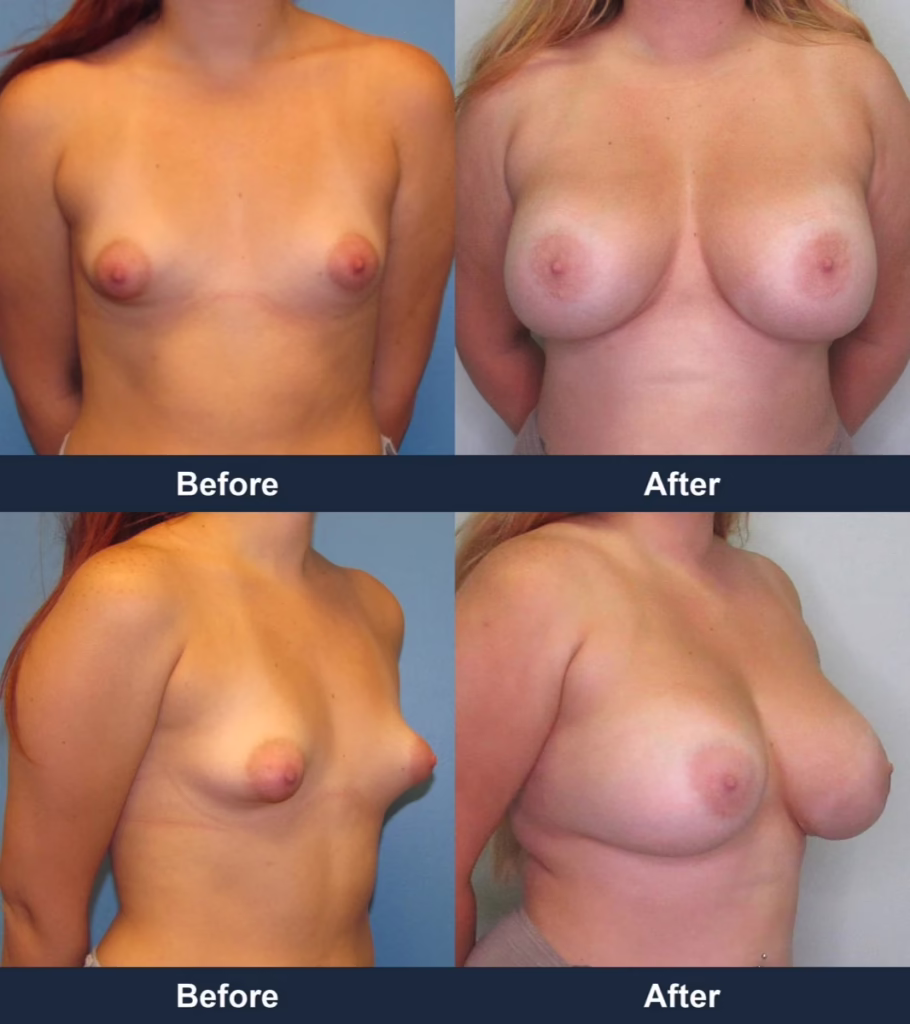 Breast Augmentation - Before and After Images with Dr. Chaudhari