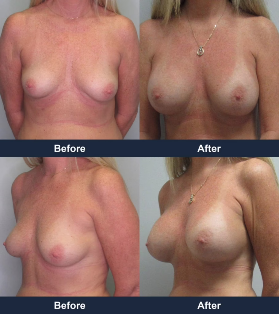 Breast Augmentation - Before and After Images with Dr. Chaudhari