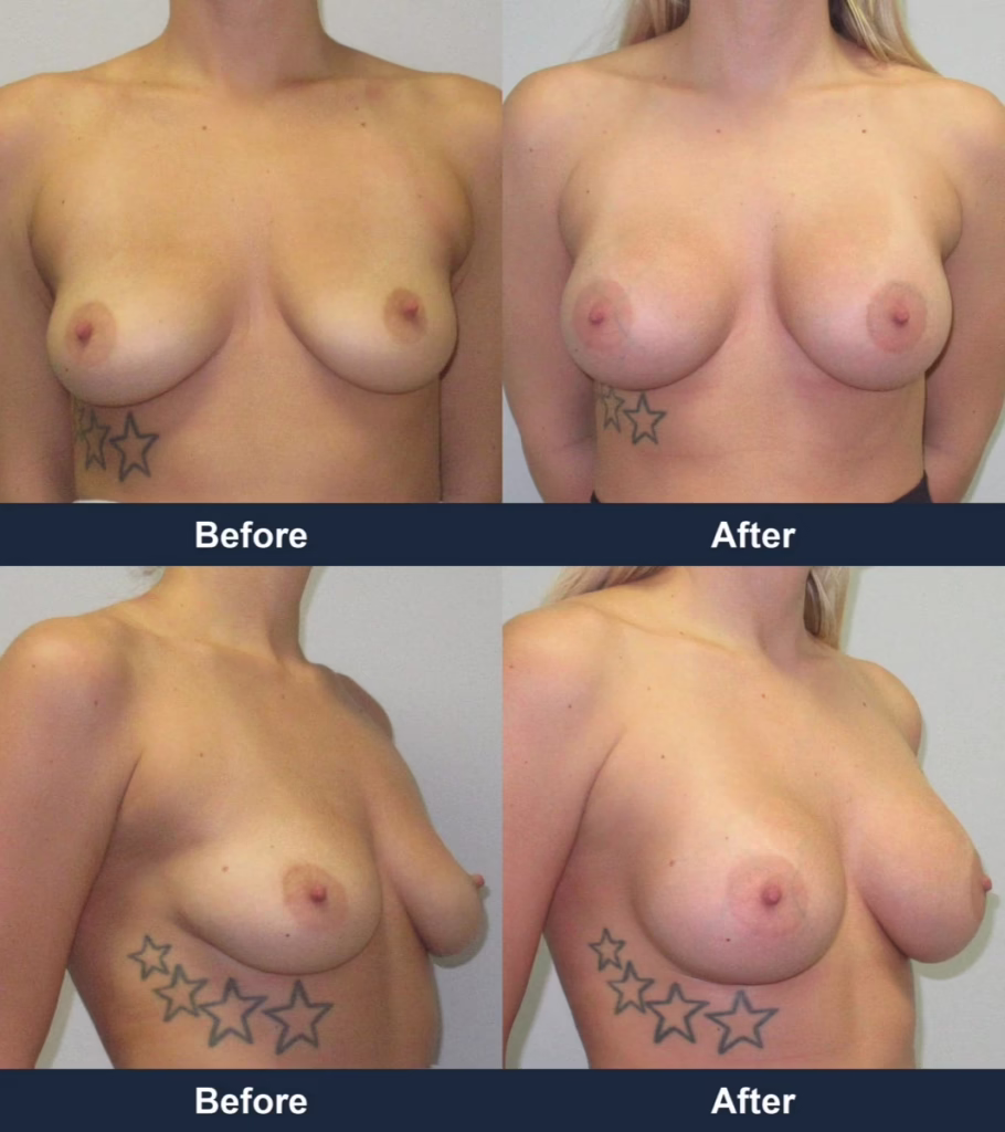 Breast Augmentation - Before and After Images with Dr. Chaudhari