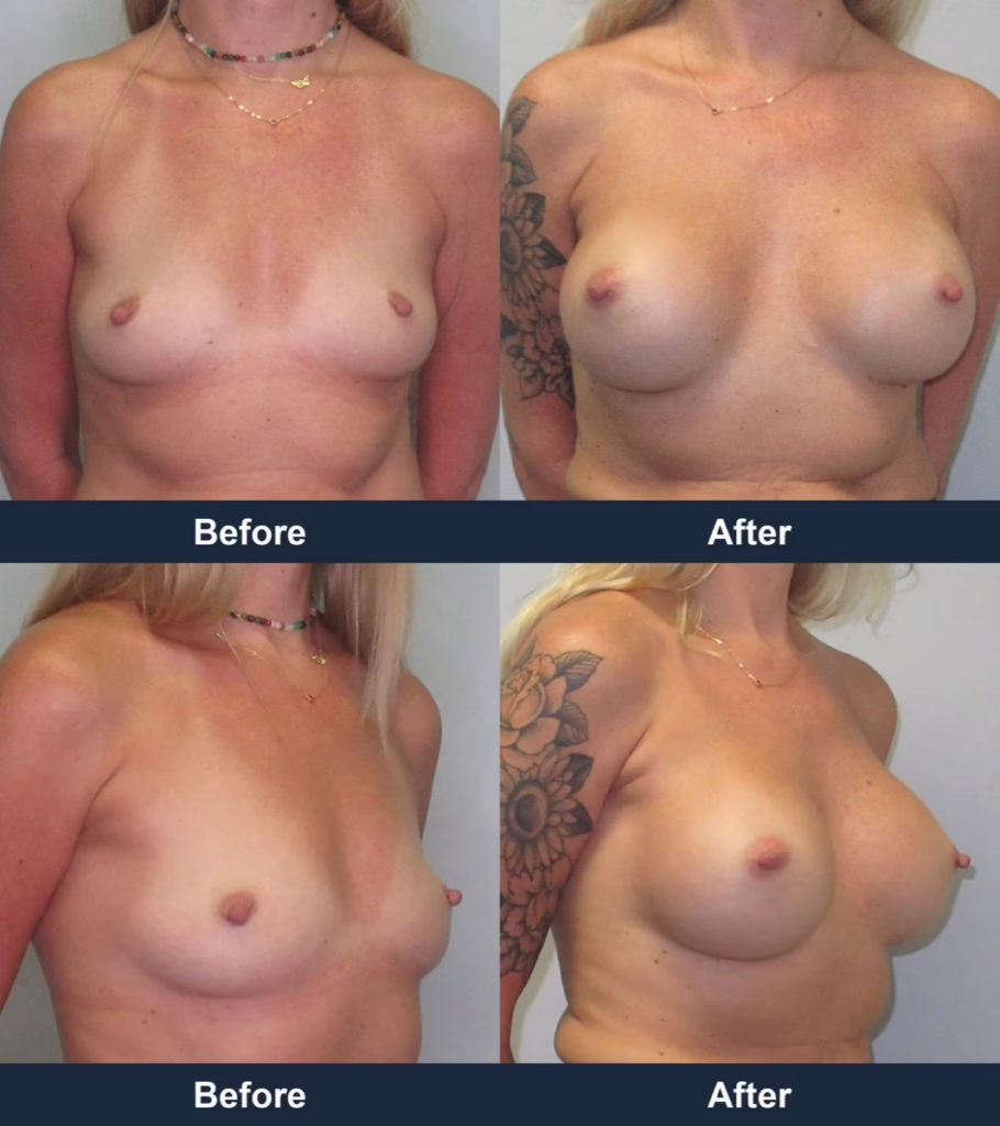 Breast Augmentation - Before and After Images with Dr. Chaudhari
