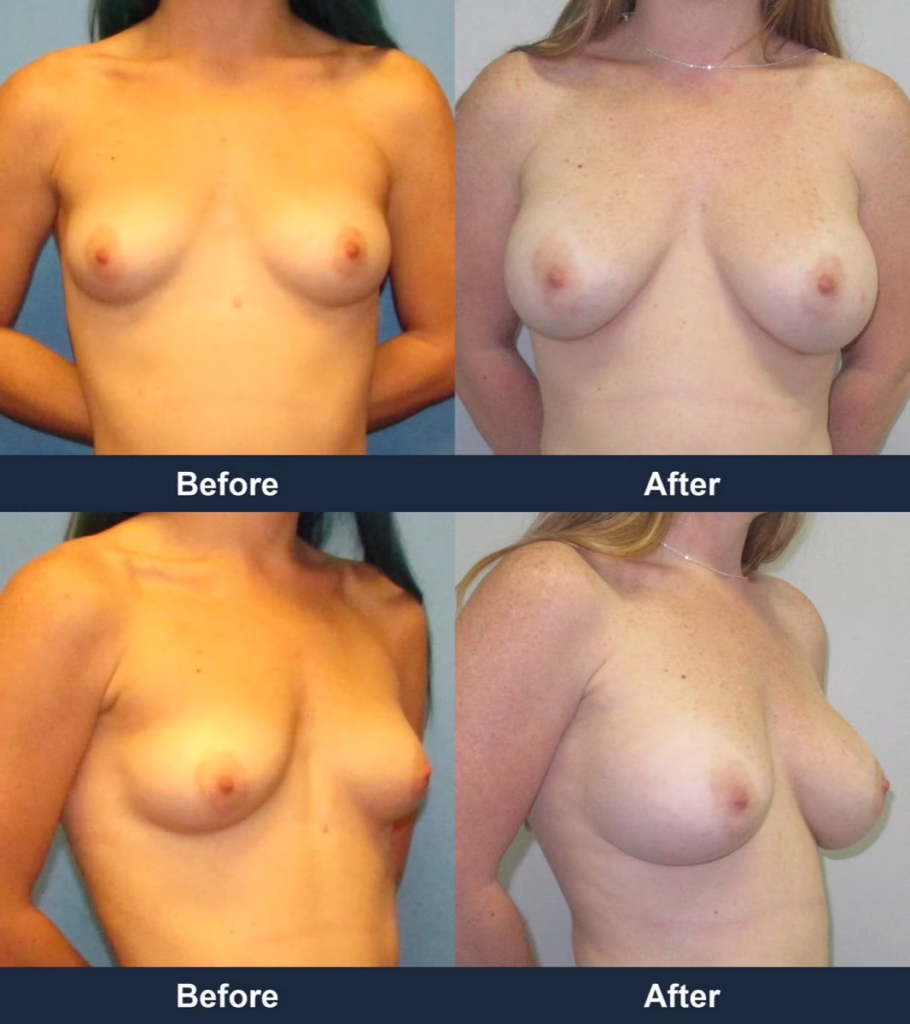 Breast Augmentation - Before and After Images with Dr. Chaudhari