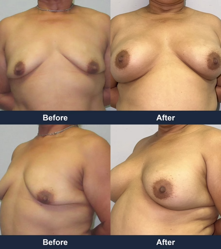 Breast Augmentation - Before and After Images with Dr. Chaudhari