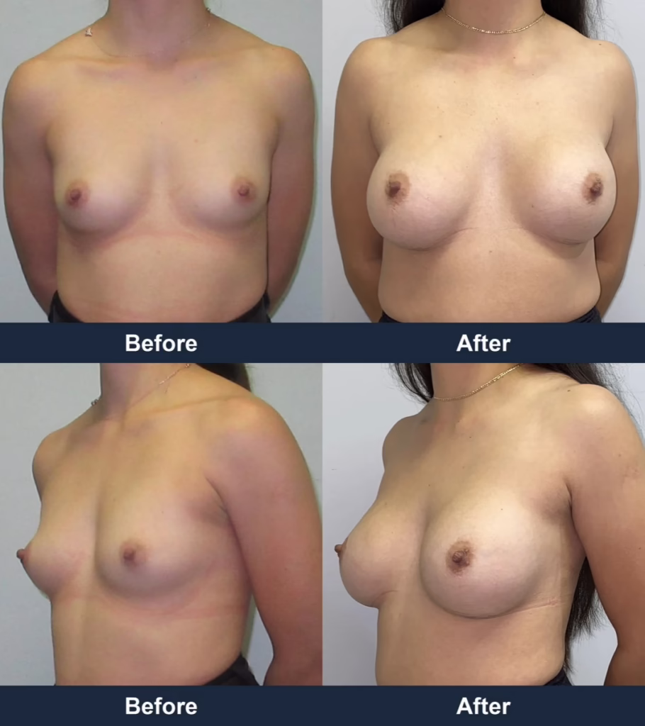 Breast Augmentation - Before and After Images with Dr. Chaudhari