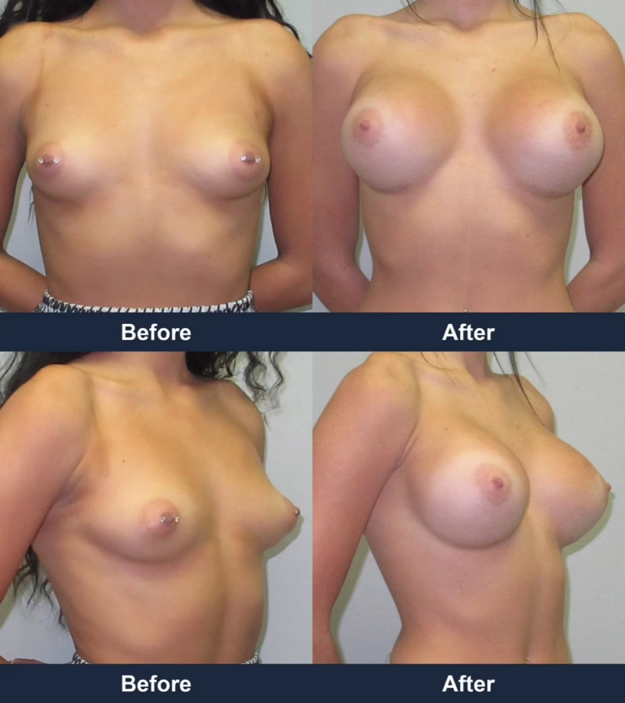Breast Augmentation - Before and After Images with Dr. Chaudhari