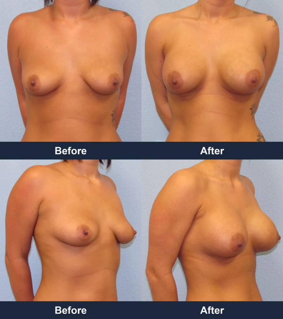 Breast Augmentation - Before and After Images with Dr. Chaudhari