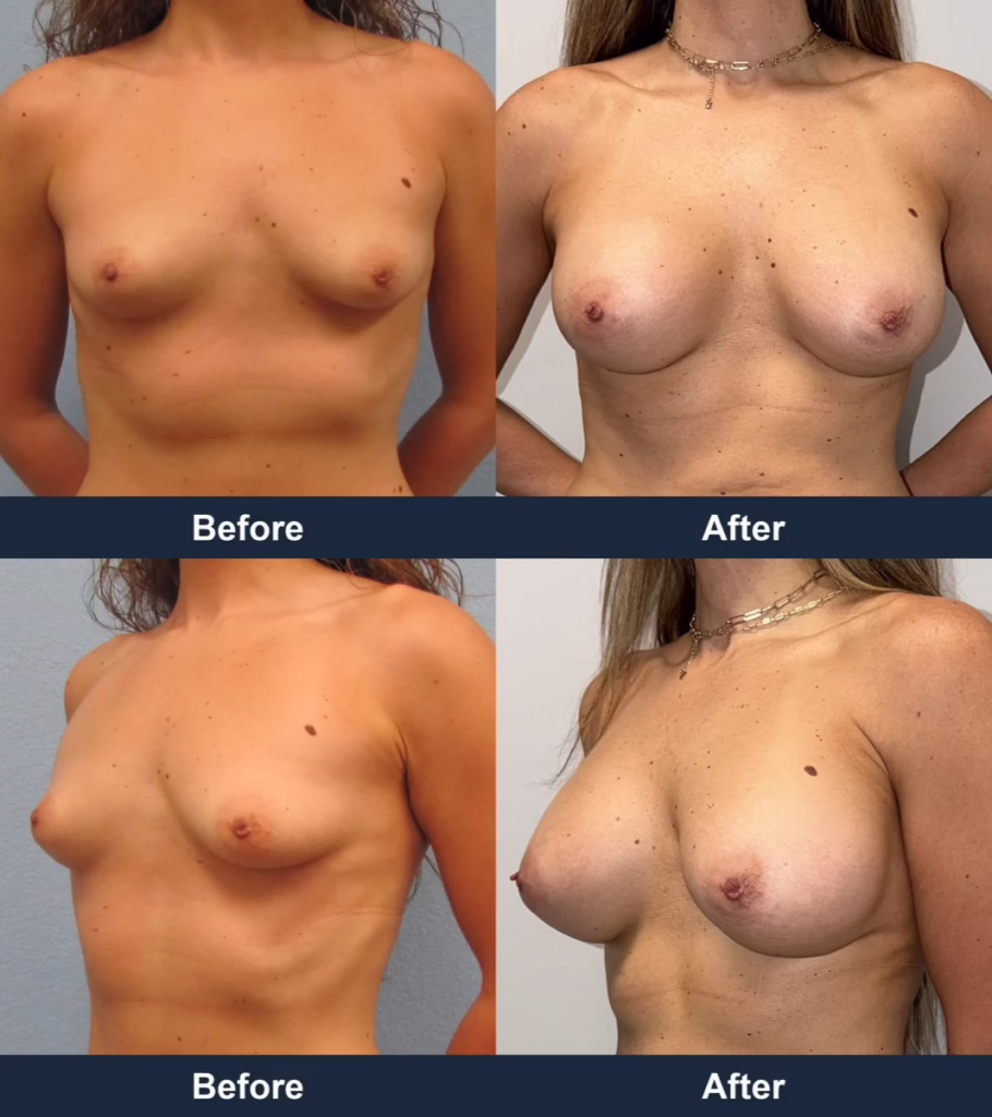 Breast Augmentation - Before and After Images with Dr. Chaudhari