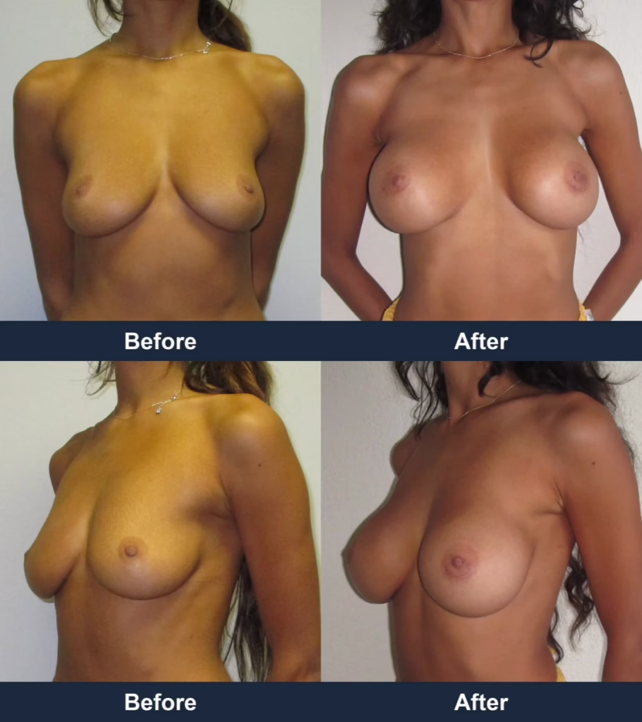 Breast Augmentation - Before and After Images with Dr. Chaudhari