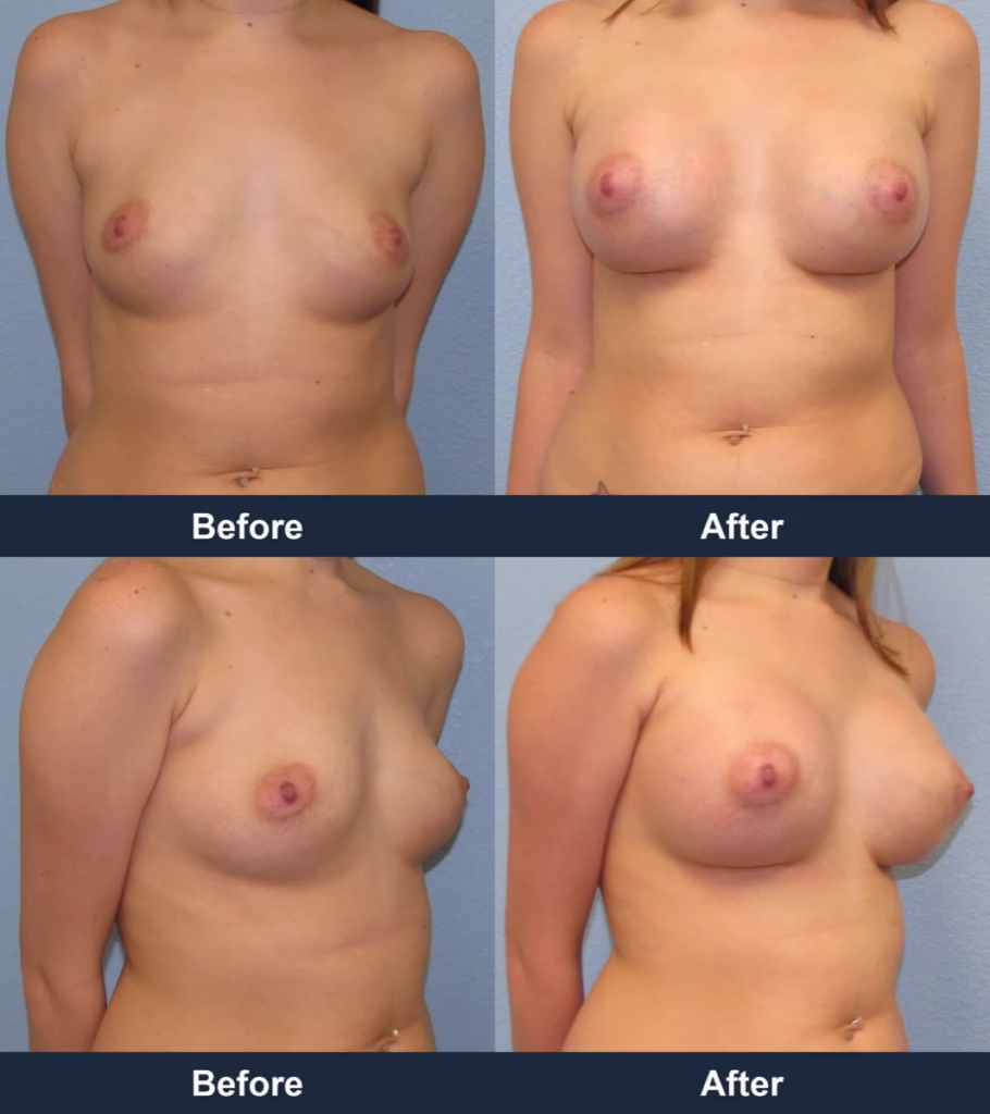 Breast Augmentation - Before and After Images with Dr. Chaudhari