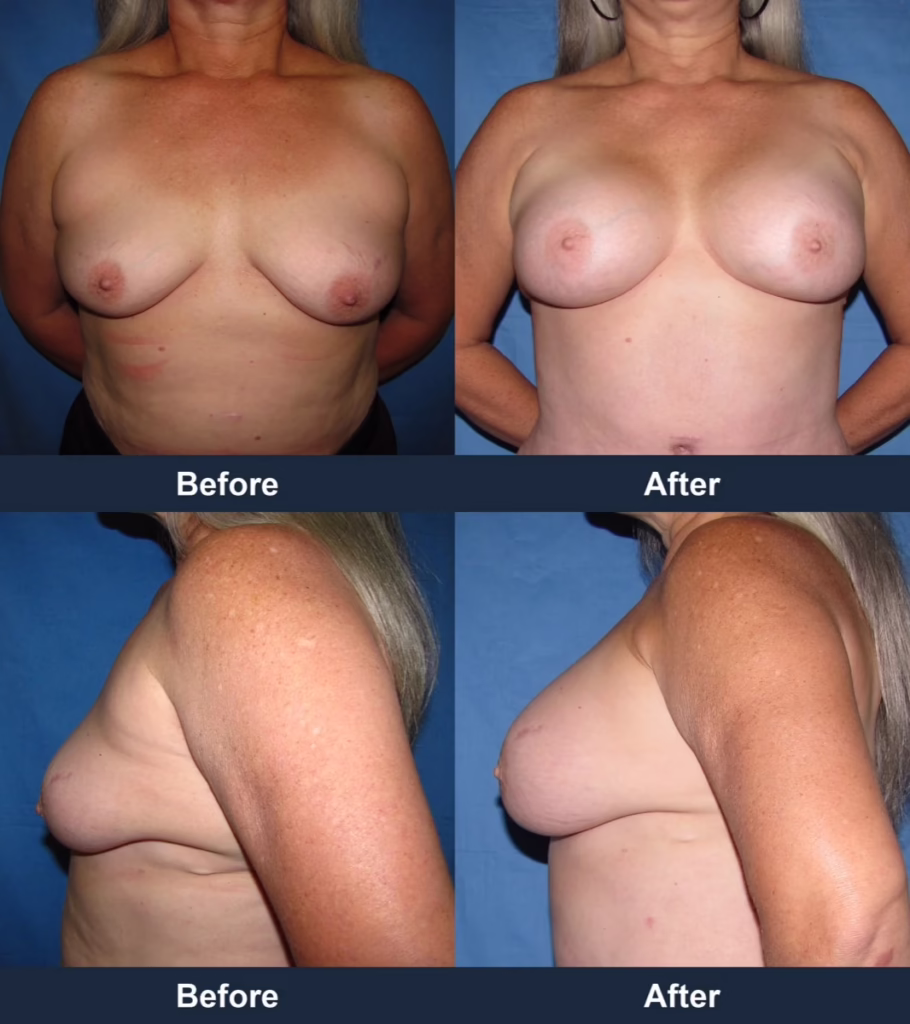 Breast Augmentation - Before and After Images with Dr. Chaudhari