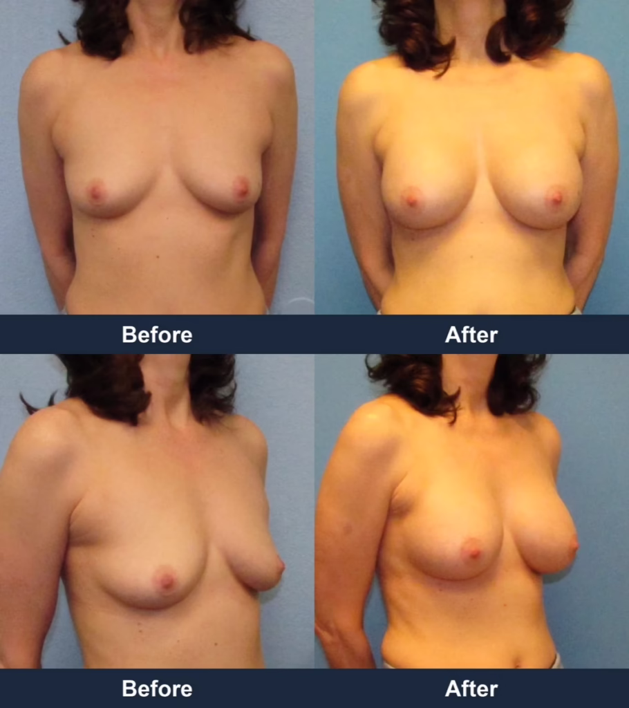 Breast Augmentation - Before and After Images with Dr. Chaudhari